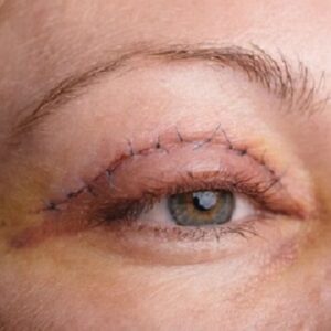 Blefaroplastia Superior
